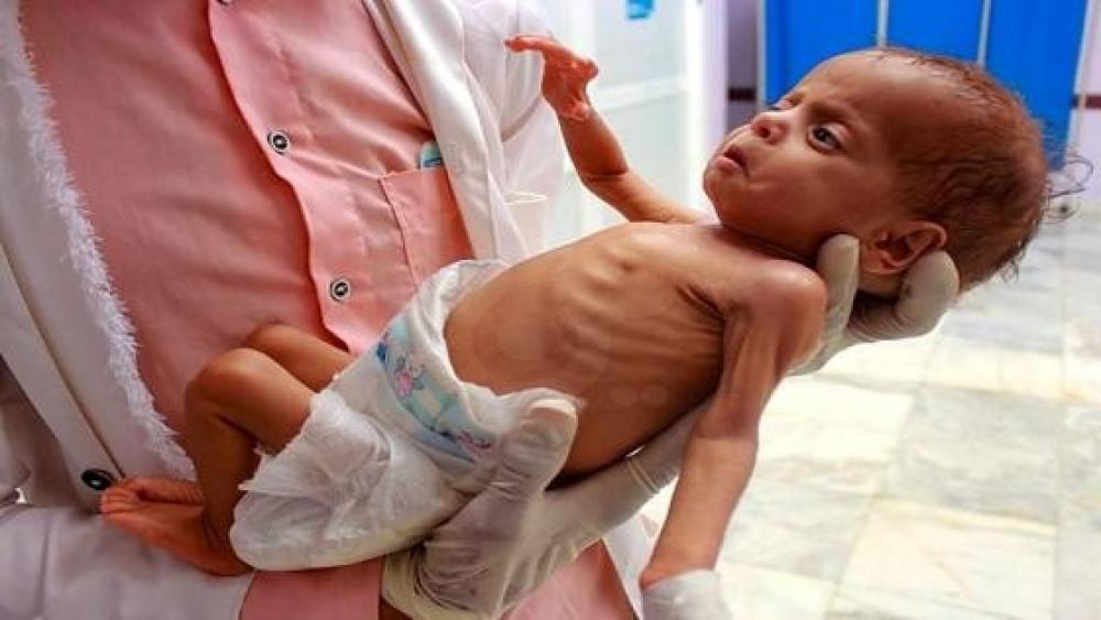 Doctors Without Borders warns of unprecedented rise in malnutrition rates in Gaza