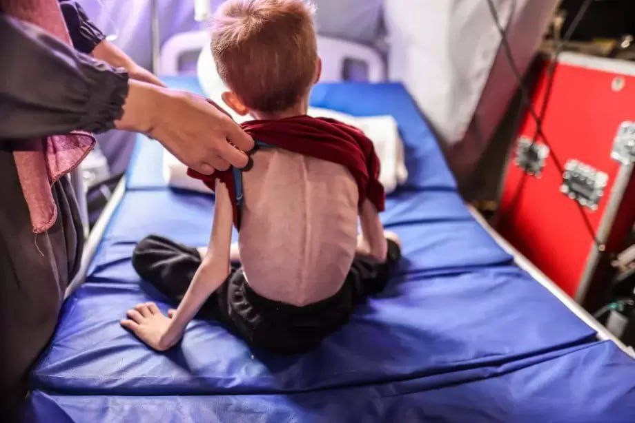 UNRWA: Significant Increase in Malnutrition Cases in Gaza Strip