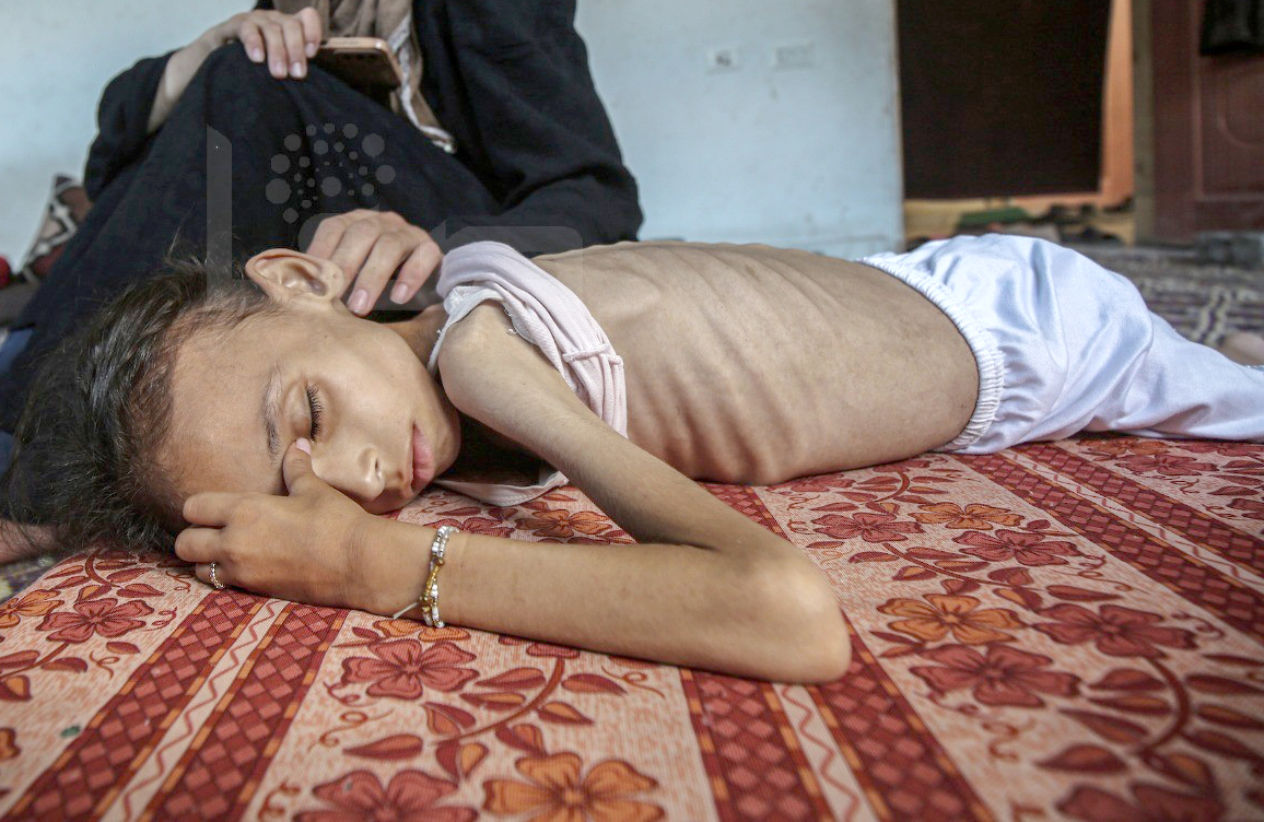 Starvation as a Weapon: 5 More Martyred in Gaza, Death Toll Rises to 180