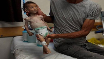 مدير مستشفى الأطفال بناصر: المجاعة تهدد الجميع في غزة