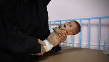 422 شهيدًا جرّاء التجويع في غزة بينهم 145 طفلاُ
