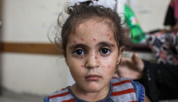 الإغاثة الطبية في غزة: 5 آلاف إصابة أسبوعيًا بجدري الماء في القطاع جراء الحصار الصهيوني