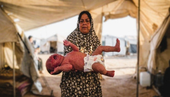 10 آلاف إصابة بجدري الماء ووفاة طفل وسط تدهور صحي متسارع في غزة