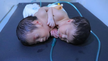 توأم سيامي بصنعاء يبحث عن فرصة للحياة في ظل العدوان والحصار