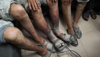 الجرب ينهش أجساد الأسرى الفلسطينيين.. نقص العلاج يفاقم المعاناة داخل سجون العدو