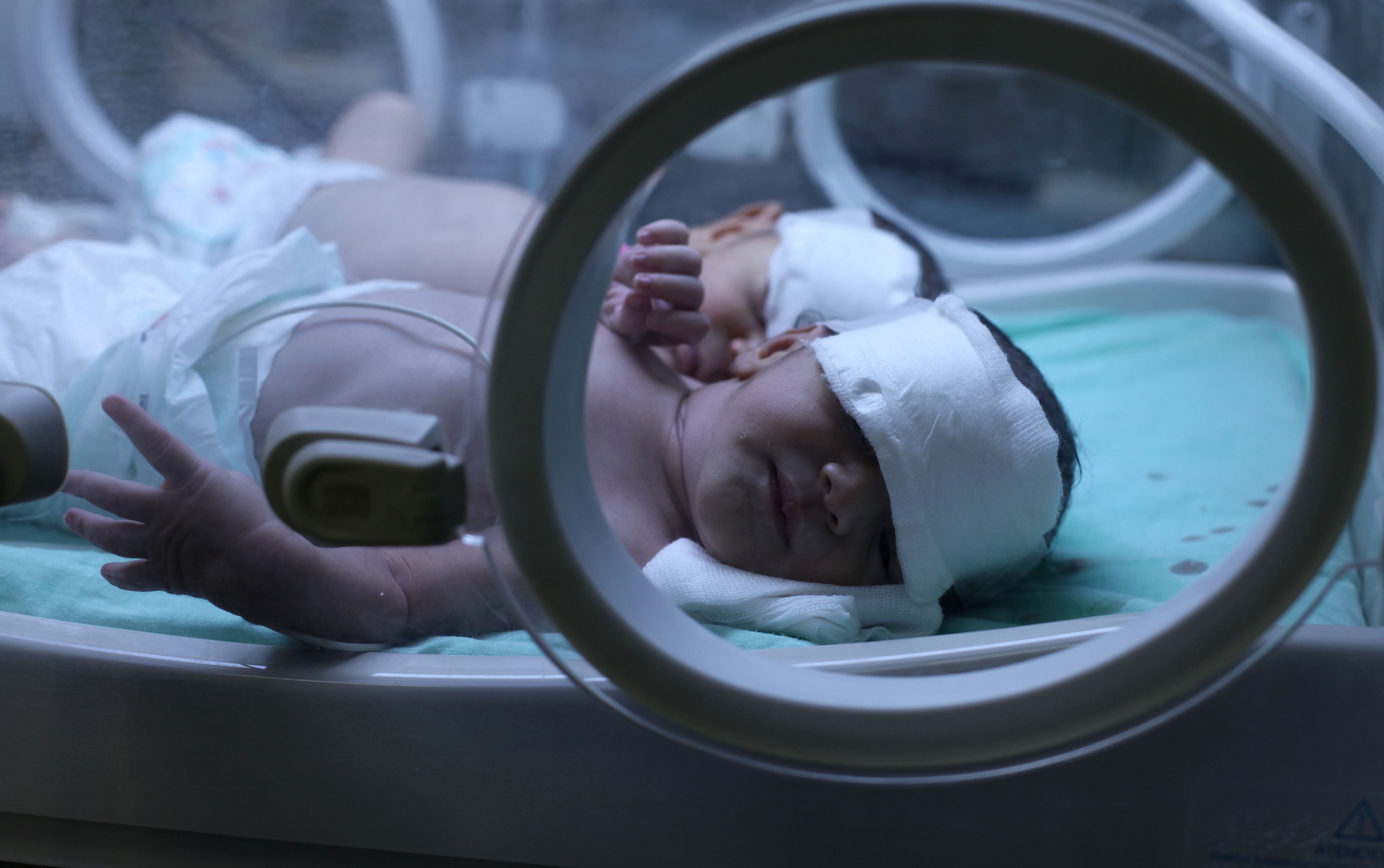 مجمع ناصر الطبي: نقص مغذيات الحوامل أنتج أجنة مشوهة