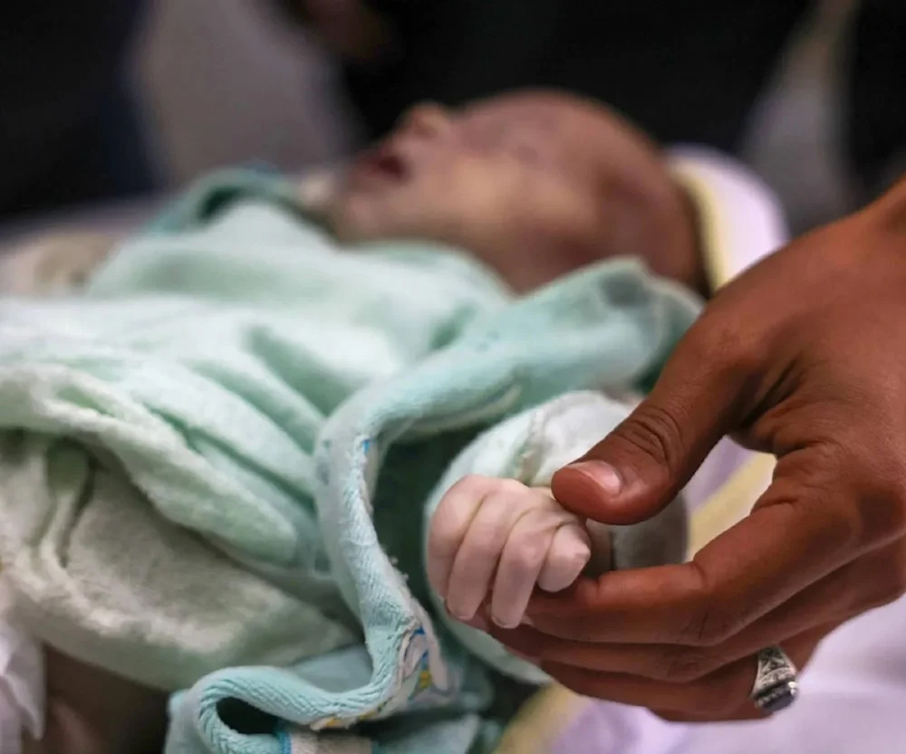 استشهاد رضيعين جراء سوء التغذية في قطاع غزة