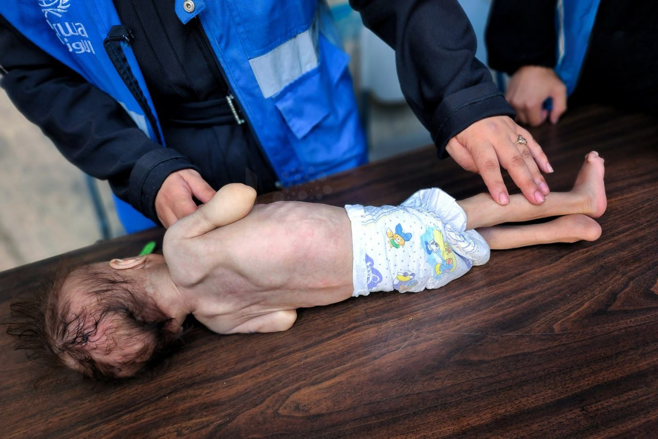 المجاعة تفتك بحياة طفلة فلسطينية في قطاع غزة