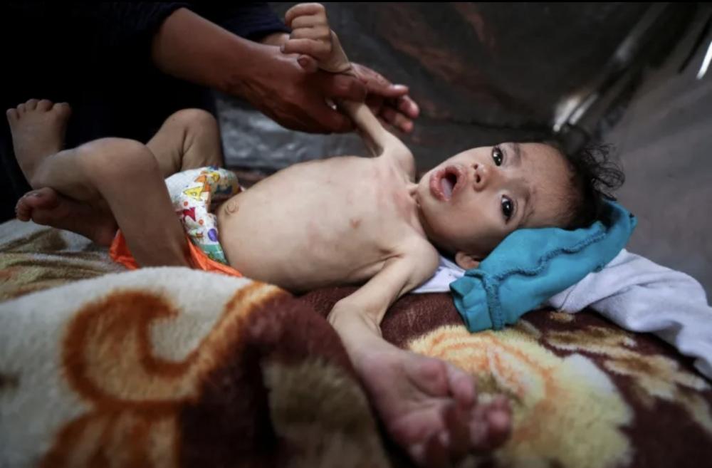 مدير الإغاثة الطبية في غزة: سوء التغذية يهدد حياة الأطفال والحوامل