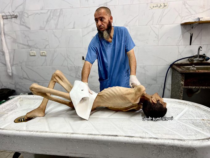 بمشهدٍ مروّع.. وفاة شابين بسوء التغذية وحرب التجويع الإسرائيلية بغزة