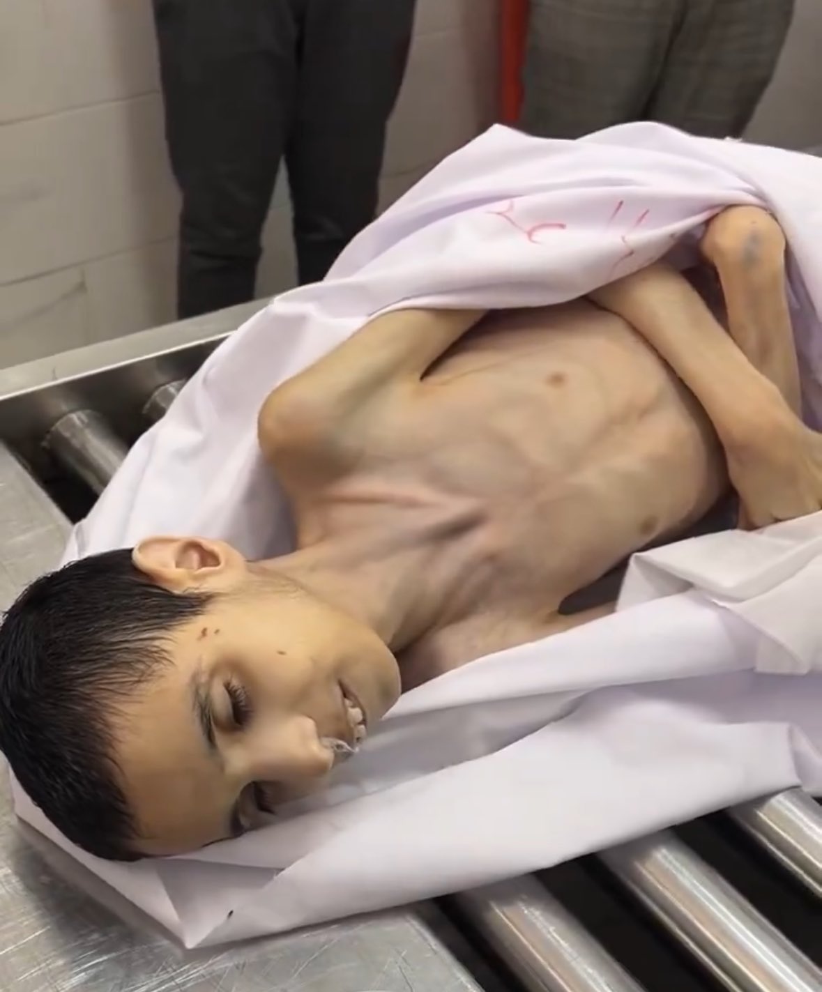 3 حالات وفاة منهم طفلان بالتجويع الإسرائيلي في غزة