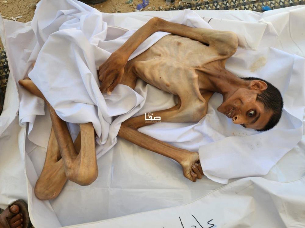 مدير الإغاثة الطبية بغزة: المجوَّعون يتوفون باستمرار لشح الإمكانيات