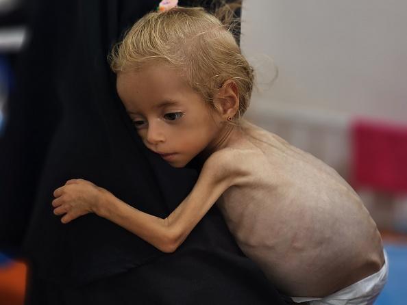 5 وفيات جديدة بغزة بسبب سوء التغذية خلال 24 ساعة