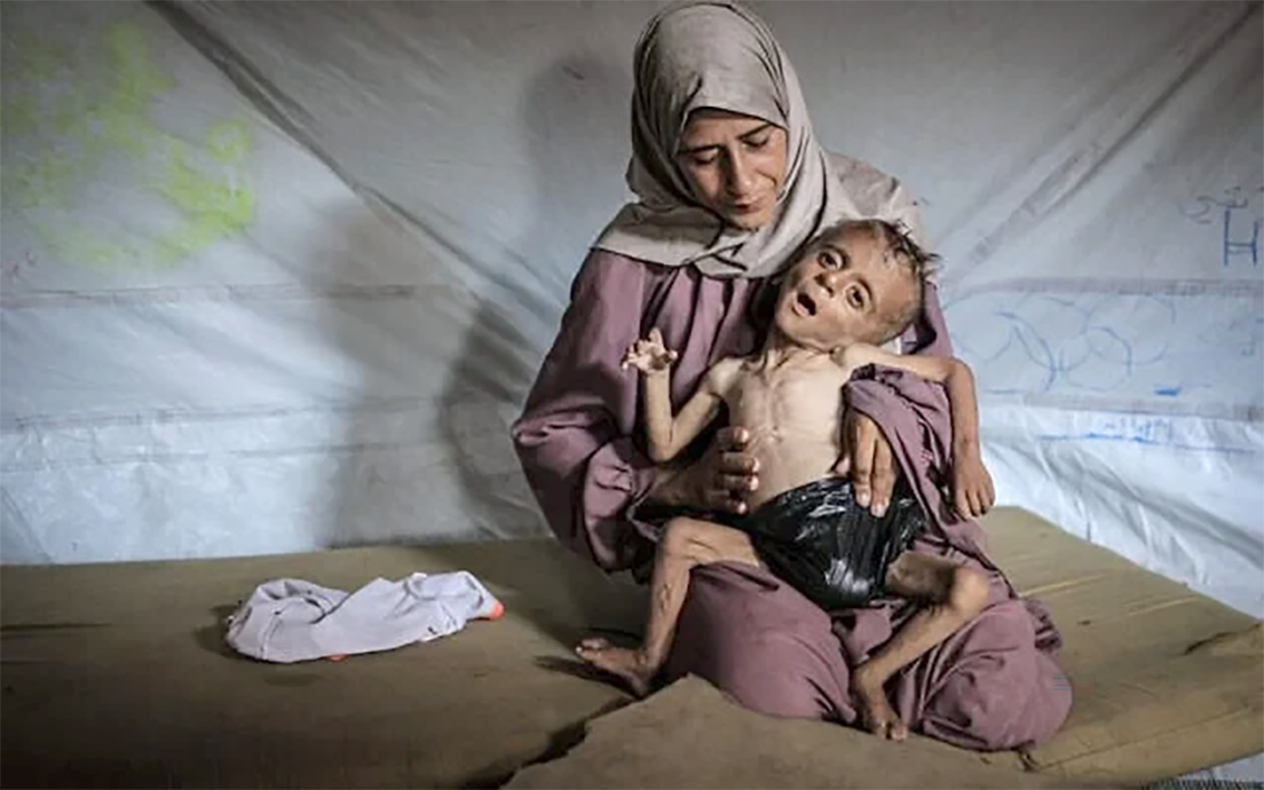 ارتفاع حالات سوء التغذية الحاد بغزة إلى 95 ألف حالة