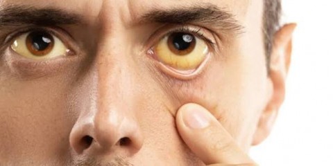 علامات في العين قد تشير إلى مشكلات في الكبد