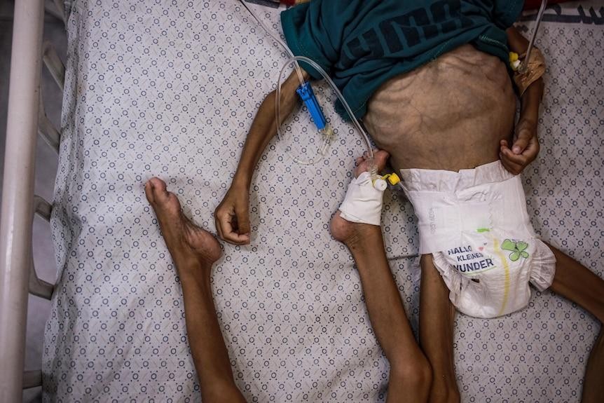 460 شهيدًا بسبب هندسة التجويع .. 650 ألف طفل في غزة مهددون بسوء التغذية جراء حرب الإبادة